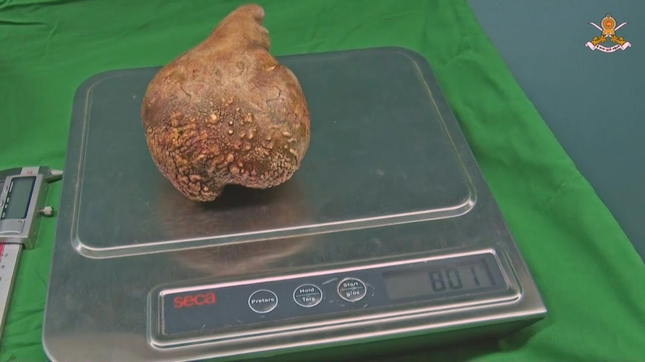 piedras en el riñon imagenes reales